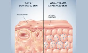 Using Hyaluronic Acid to Treat Oily Skin