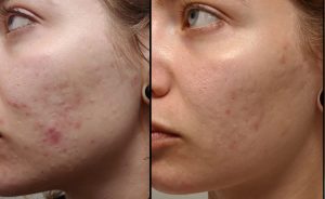 Fighting acne and minimizing wrinkles