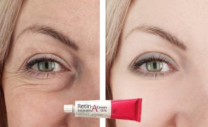 Retin A Before and After: Stunning Transformations