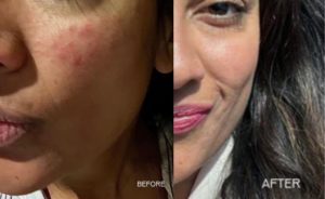 Retin A Before and After