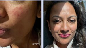 Tretinoin Before and After: visual proof