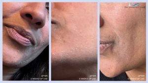 Tretinoin Before and After: Remarkable Skin Transformations
