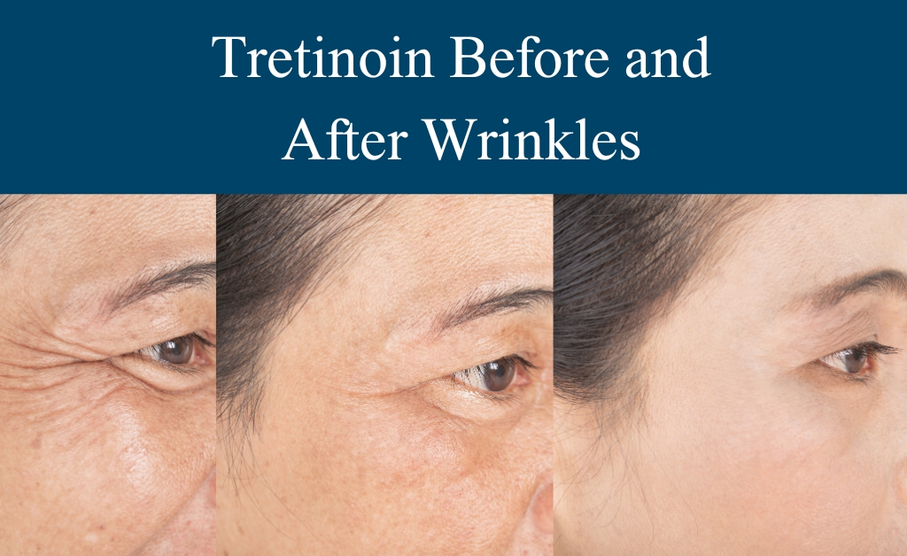 Tretinoin Before And After Wrinkles Stunning Results 