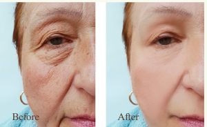Tretinoin Results