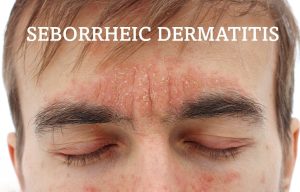 Seborrheic Dermatitis