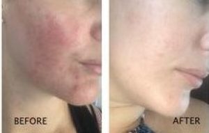 jojoba oil before after image