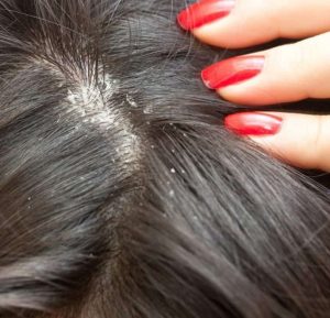 Jojoba Oil for Seborrheic Dermatitis: Heal Your Skin!