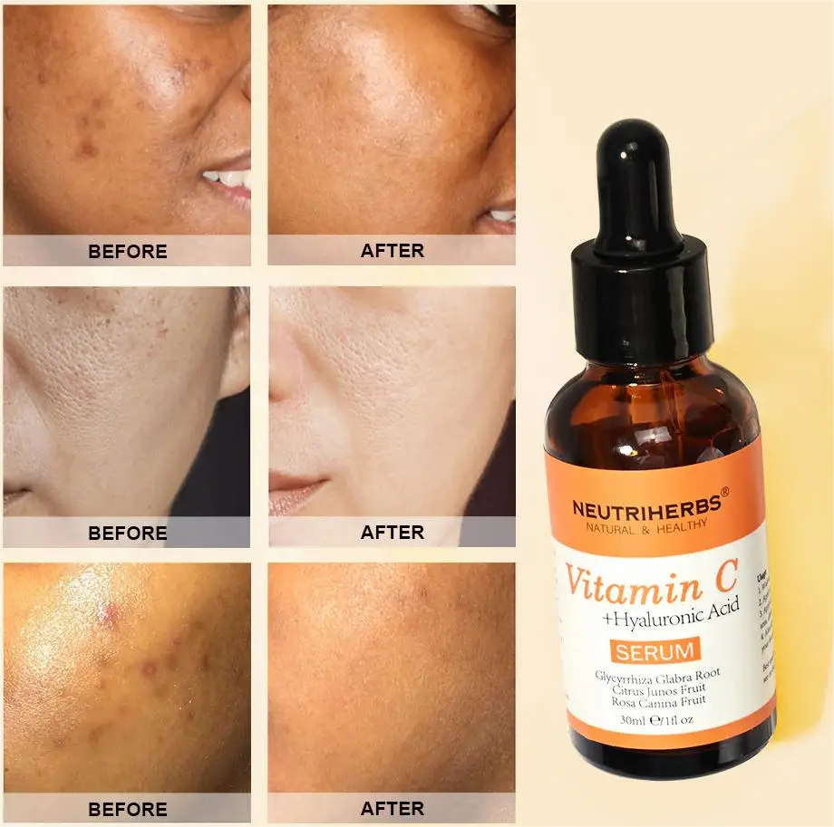 Vitamin C Serum Before and After