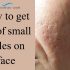 How to Remove Deep Chicken Pox Scars Naturally? 6 remedies
